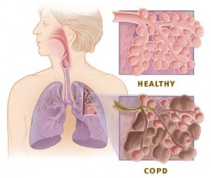 健康与Copd肺（礼貌的国家心肺和血液研究所）